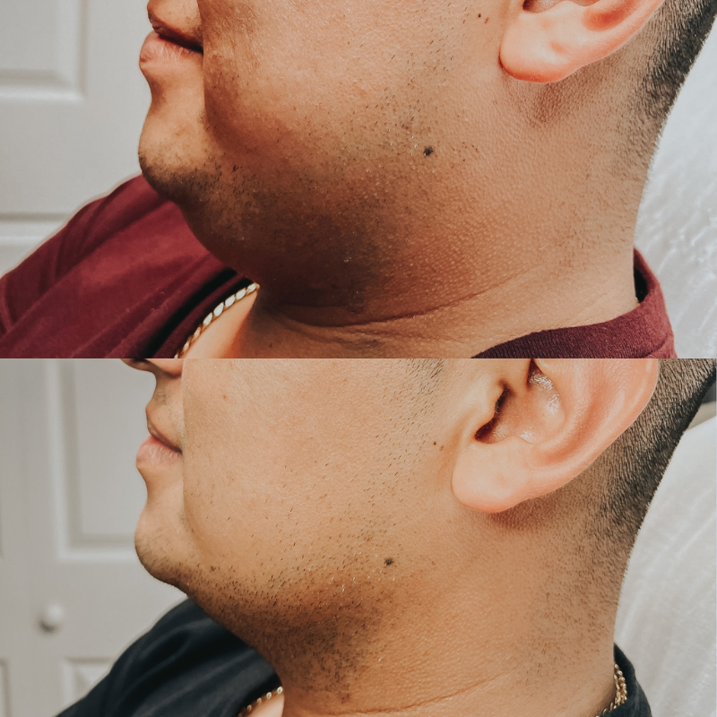 two combinations of one face before and after treatment